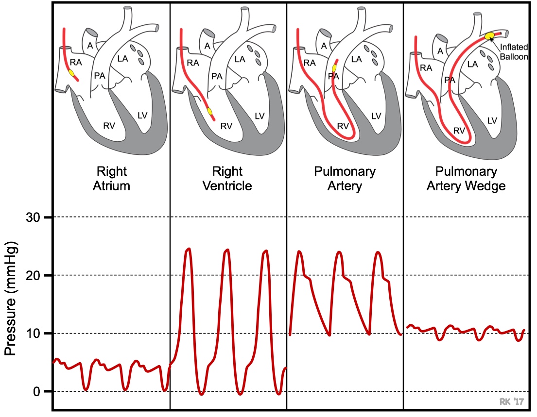 Swan-Ganz pressure waveforms