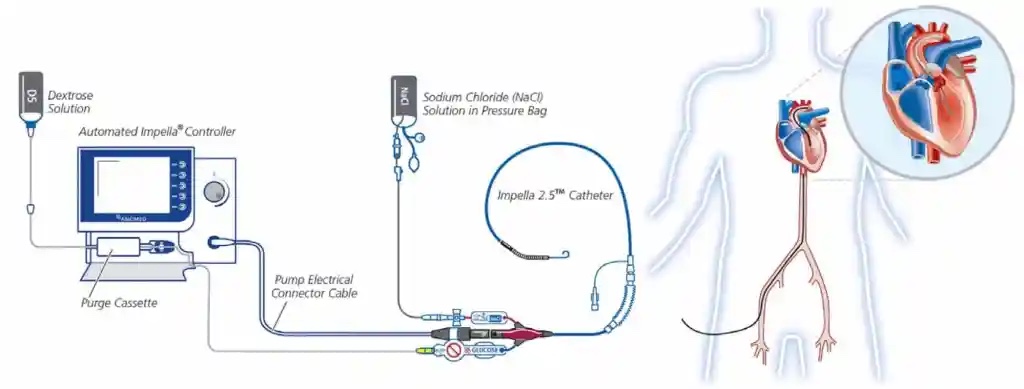 Impella pump setup