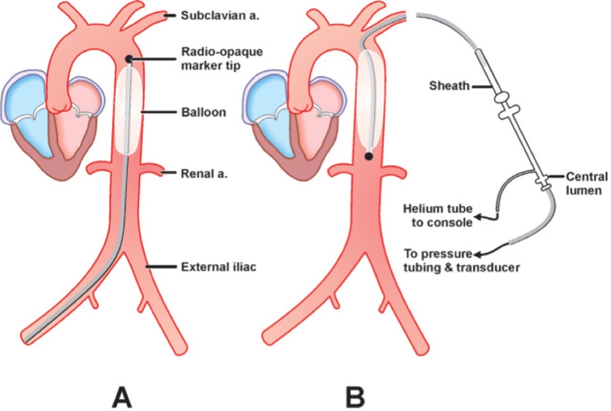 IABP anatomical placement