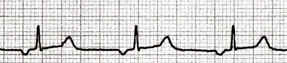 ECG showing ectopic atrial rhythm