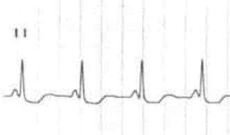 Lown-Ganong-Levine pattern with short PR and normal QRS