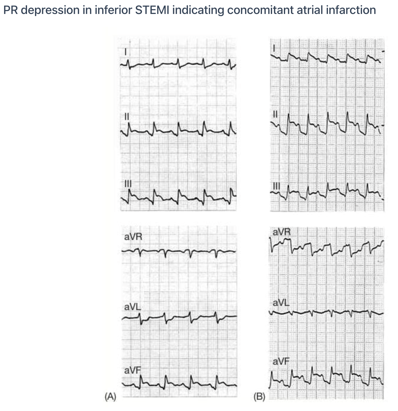 Atrial infarction with PR segment depression