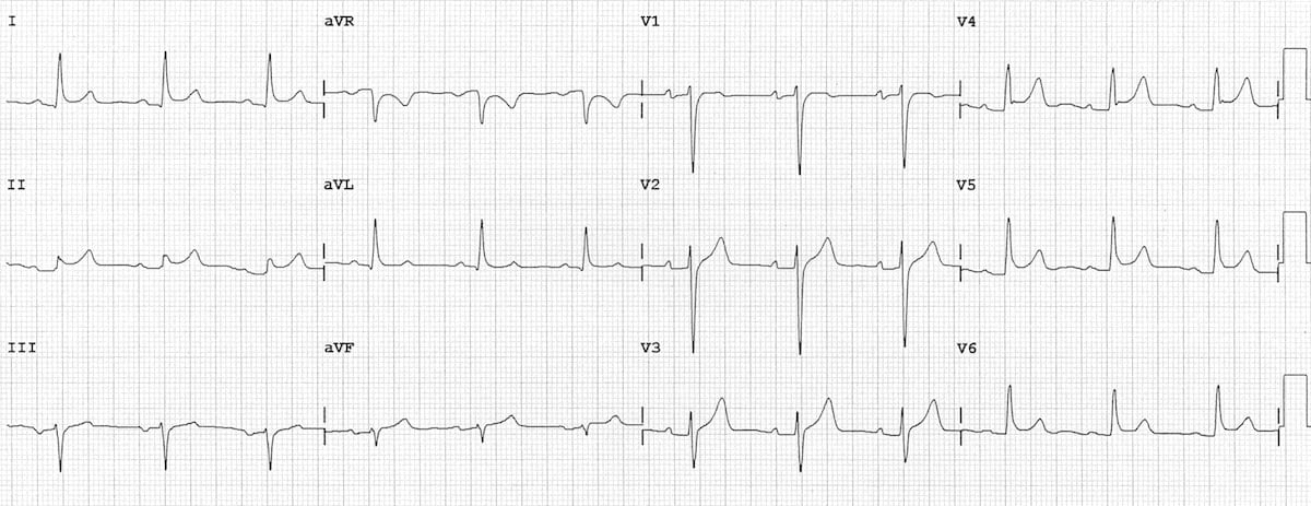 ECG stages of acute pericarditis showing evolution of PR and ST changes