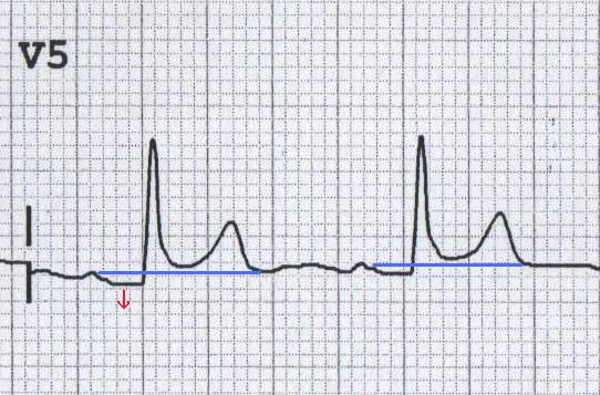PR segment depression in acute pericarditis