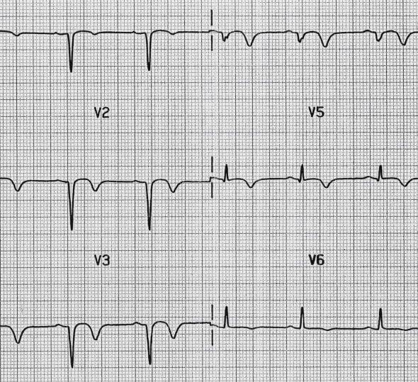 Anterior Q waves post recent MI