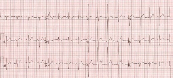 Muscular dystrophy ECG pattern