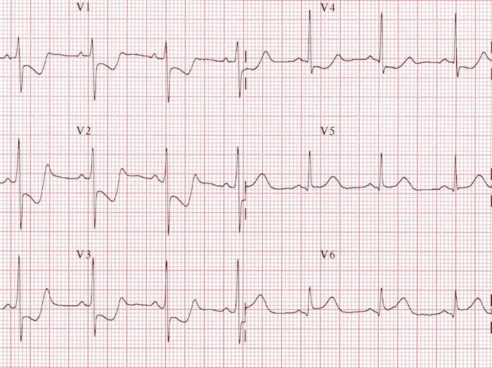 Posterior MI with tall R waves in V1-V2