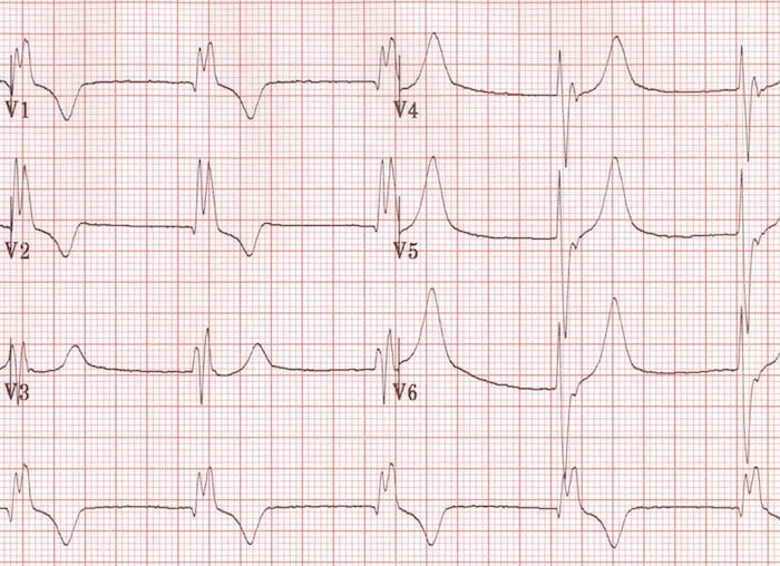 Right bundle branch block with rSR' in V1