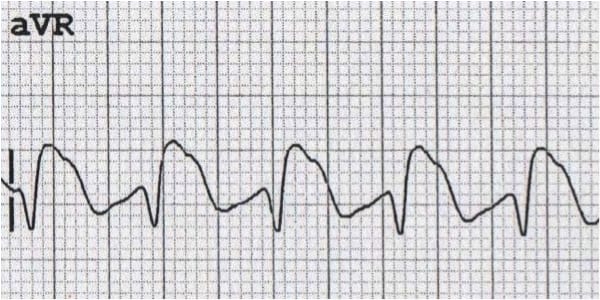 Sodium channel blocker poisoning showing tall R in aVR
