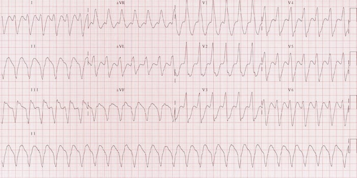 Ventricular tachycardia with dominant R in aVR