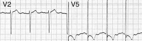 LVH with deep S waves