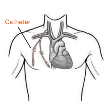 Hemodialysis catheter showing tunneled central venous access