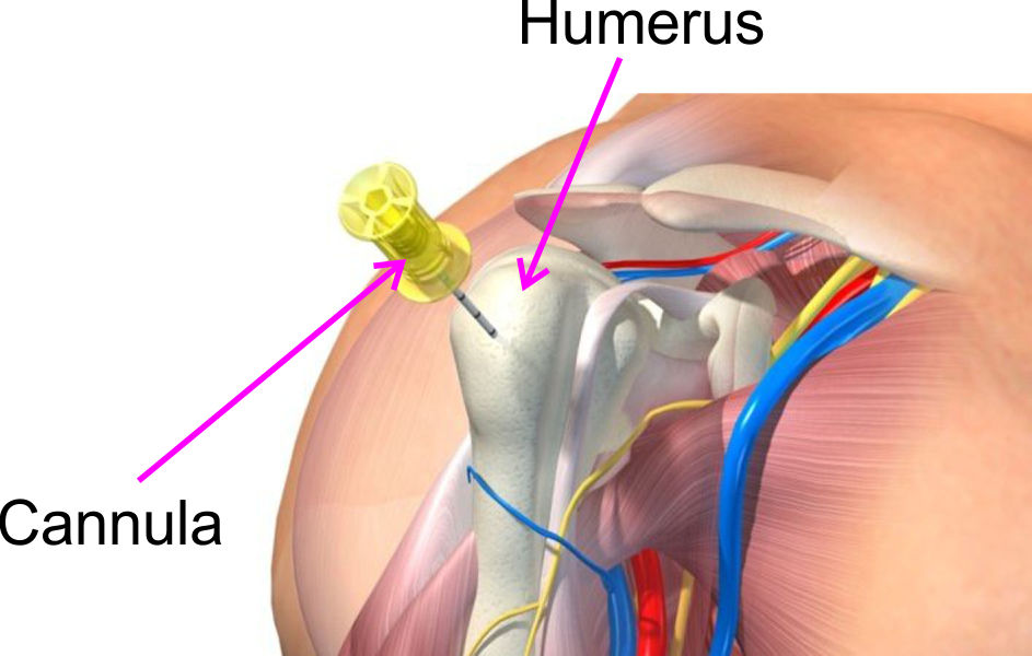 Proximal humerus anatomy for IO insertion