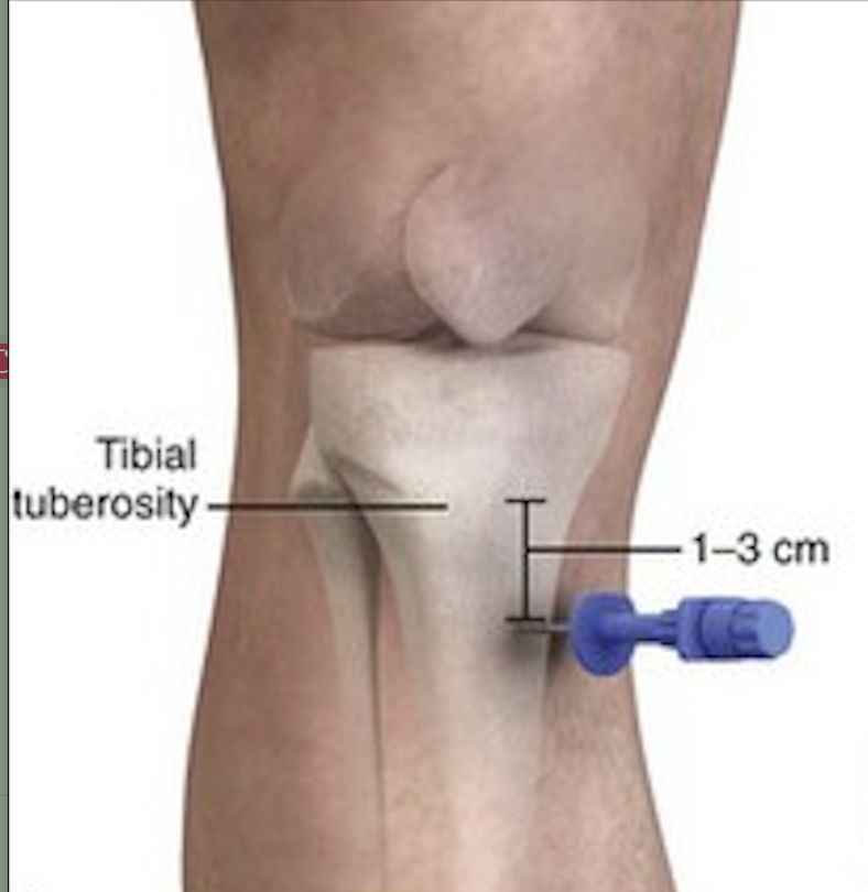 Proximal tibia anatomy for IO insertion