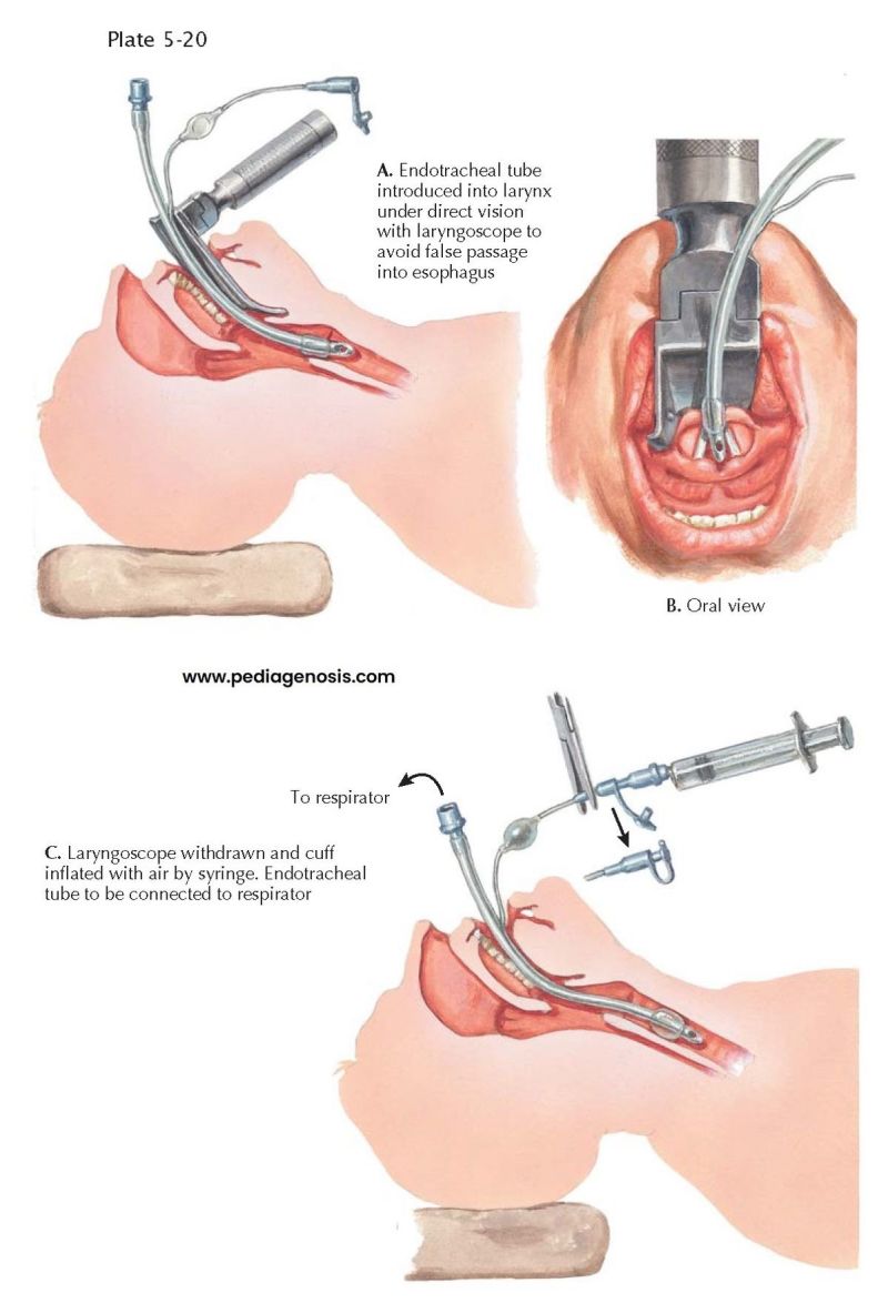 Endotracheal intubation overview showing airway anatomy and tube placement