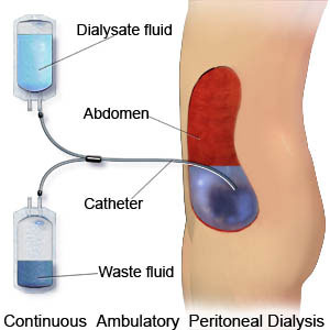 Basic peritoneal dialysis diagram showing the peritoneal cavity, PD catheter, dialysate in the abdomen, and blood vessels in the peritoneum