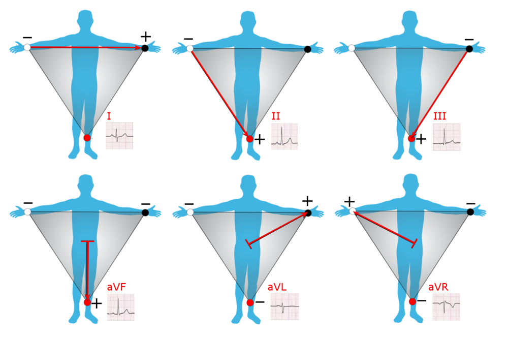 Einthoven's Triangle diagram showing Lead I, II, and III relationships
